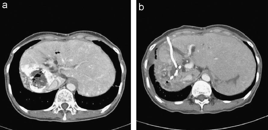 166 J.H. Kim et al. Figure 3 Follow-up CTscan six months after surgery: (a) CT scan revealed liver abscess and (b) after percutaneous drainage, abscess pocket decreased.