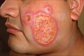 Leishmaniasis is divided into clinical