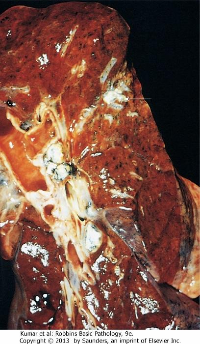 lung lesion