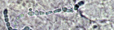 گزارش نتيجه آزمايش قارچ شناسی طريقه Direct Microscopy- (KOH