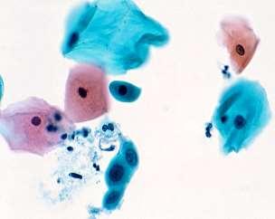 cells / hpf SurePath (13 mm): 3 to 6