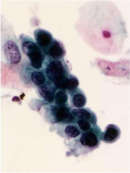Cytology: Squamous Atypia Atypical
