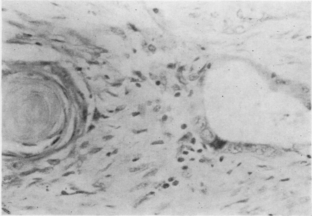 A sheet of ill-differentiated squamous cells in which are many acini lined by cubical epithelium (1,438/60). H. and E. x 110. Aw." -... k. 40. S.-. 41W.t '#' 433 Thorax: first published as 10.