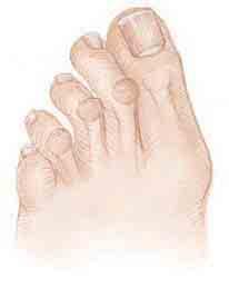 Hammer Toes Problems with the structure of the foot or too-short shoes can make toes buckle.