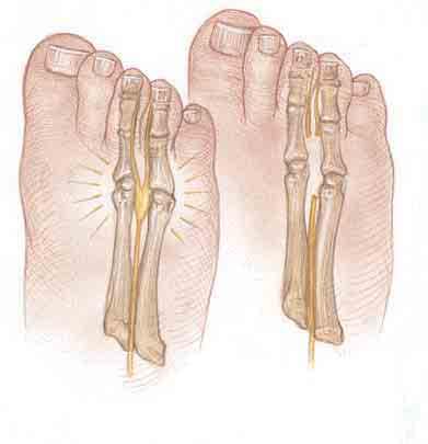 Bunions A bunion is an unsightly bump of bone on the side of the big toe. Shoes often irritate them.