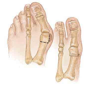 positioned metatarsal bones can cause irritation of the nerve between them.