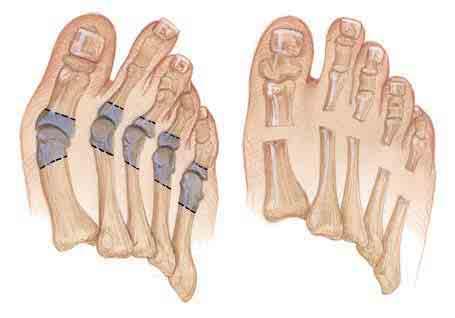 With age, toenails grow thicker and the skin gets drier.