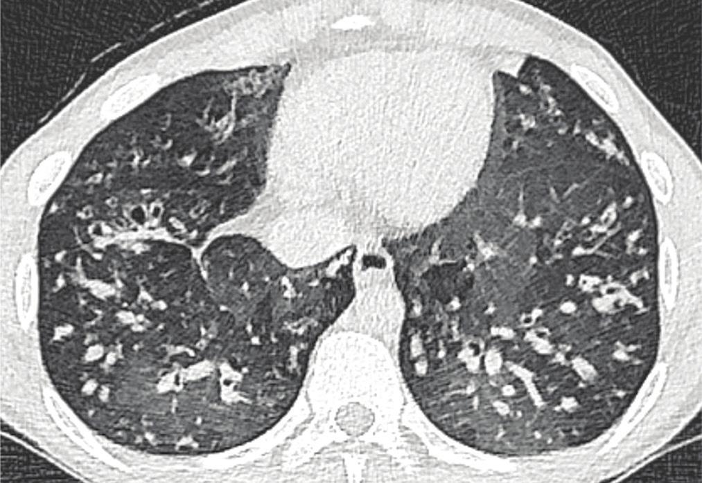Figure 2: Examples of small airways disease in chest CT scans 1)