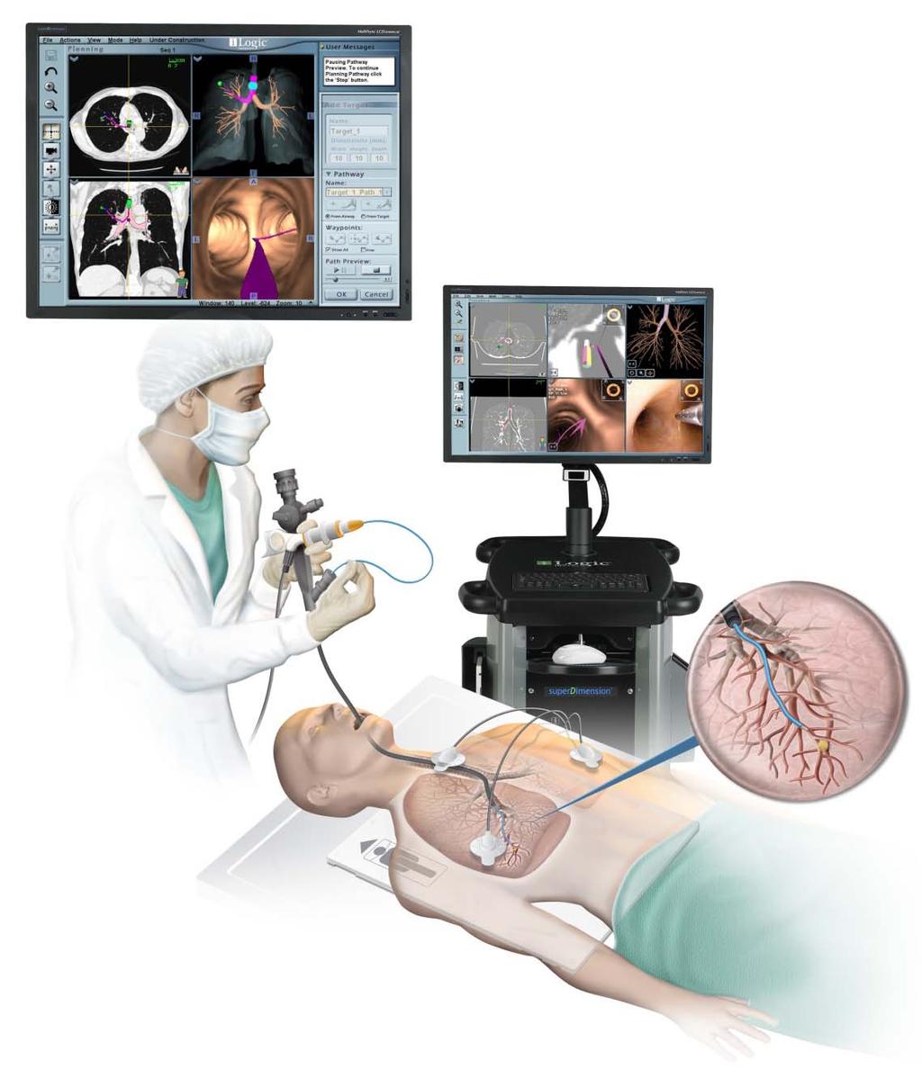 Electromagnetic Navigation Bronchoscopy (ENB) Procedure Overview Planning Screen Locatable Guide (LG): 360 steerability for navigation to lesions and lymph nodes Bronchoscopic Access: LG and EWC go