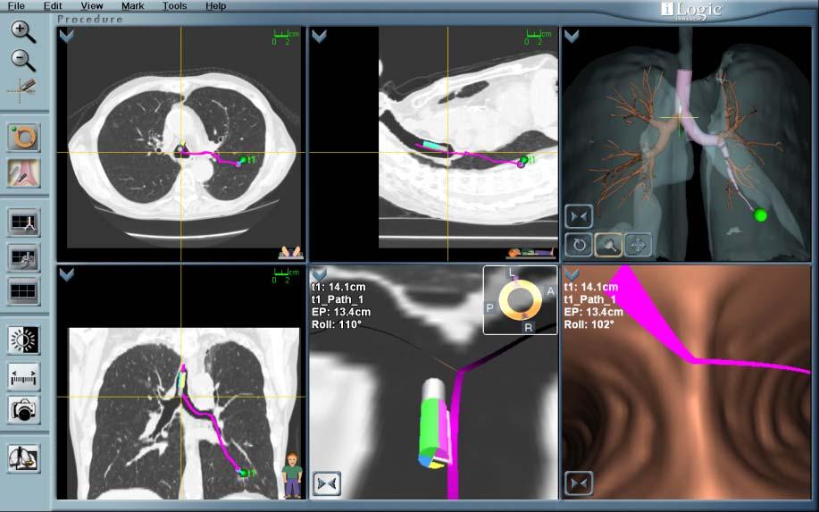 Advantages of i Logic Greater Clarity Virtual 3D bronchial tree extends deep into the lungs reaching 17+ airway generations Multiple guidance and navigation views enhance lung lesion and
