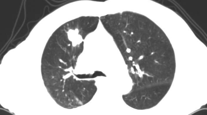 right lung.