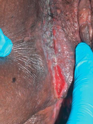 Vulvar ulcers maybe the initial manifestation in 25% of patients