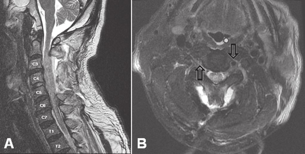 Delayed tetraplegia after CABG surgery Fig. 2. The T2-weighted image of cervical spine MRI obtained eleven days after C3-C5 laminectomy and C4-C5 discectomy with anterior bone fusion.