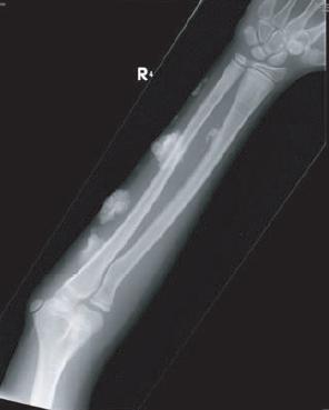 Calcinosis Soft tissue calcification, which can be