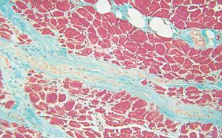 dermatomyositis atrophic, small fibers in the periphery of the fascicles