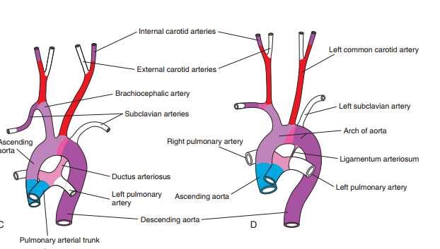 The fifth aortic arch either never forms or forms incompletely and then regresses.