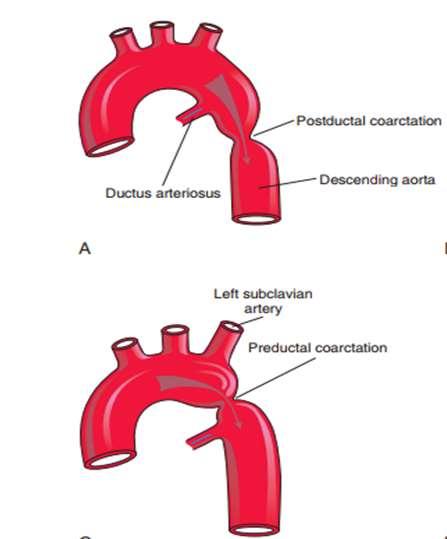 Coarctation of the aorta is a congenital narrowing of the aorta just proximal, opposite, or distal to the site of attachment of the ligamentum arteriosum However, most constrictions occur distal to