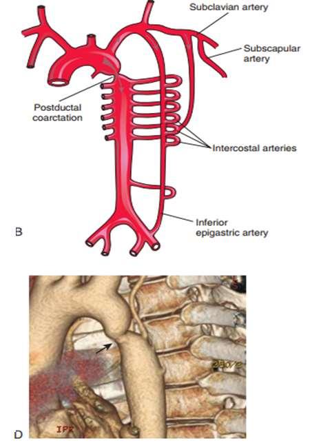 Clinically, the cardinal sign of aortic coarctation is absent or diminished pulses in the femoral arteries of both lower limbs.