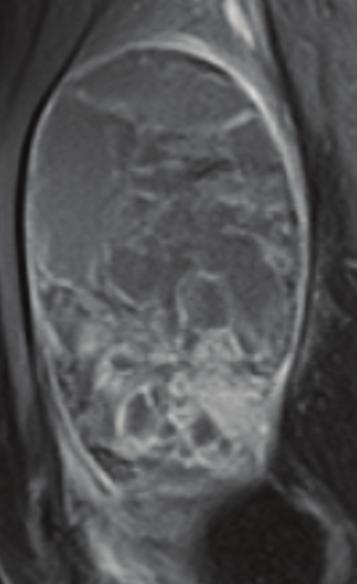 2 Sarcoma # # # Figure 1: MRI characteristics of soft tissue sarcoma with telangiectatic changes (STST) images showed typical MRI features of STST: (#) fluid-fluid levels, ( ) tumor nodules.