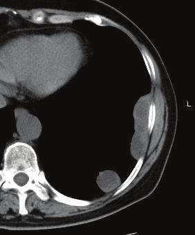 thenoduleenhancedinthetumorisoftenusedtodistinguish between hematomas and hemorrhagic neoplasms on MRI and CT scans. In our study, tumor nodules were observed in all cases.