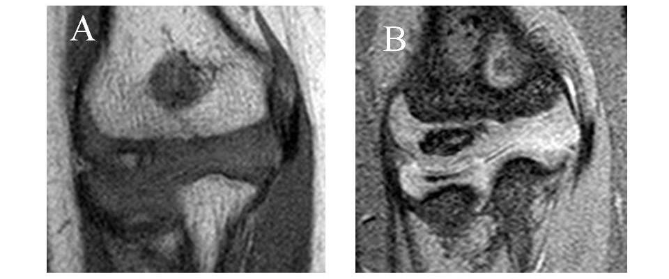 R. SAKATA et al. Figure 2. MRI findings of the elbow.
