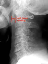 CERVICAL SPINE XRAY RED