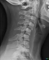 CERVICAL SPINE XRAY RED
