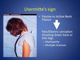 History of Symptoms Red Flags Lhermitte s