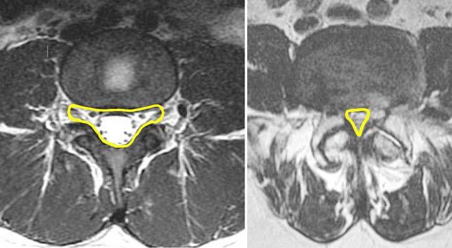 Lumbar Stenosis MRI