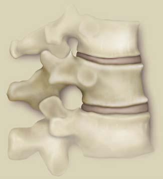 endplate(s) Wedgeshaped Spine