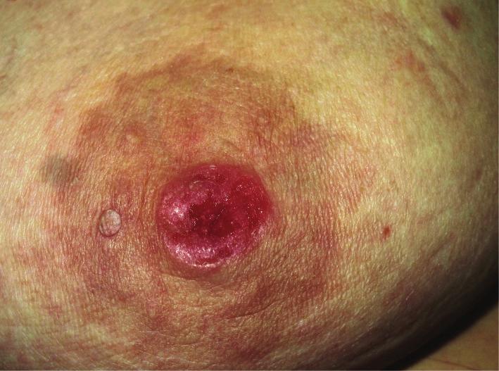 On the other hand, she had erosive lesions on her right nipple for the recent 6 months. There were ulceration and eczematous changes on the right nipple-areola complex (NAC) (Figure 3).