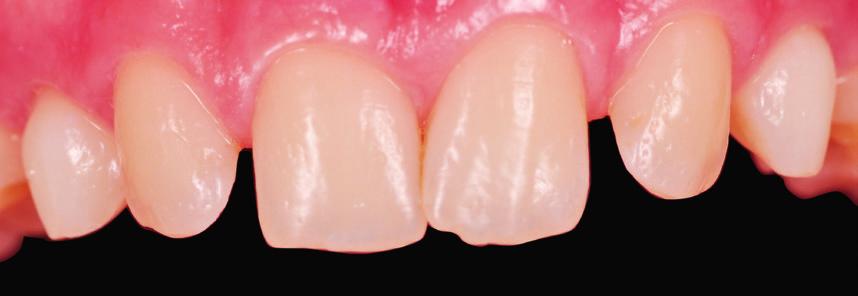 An optimized restorative material addresses all the parameters required for an esthetic, durable restoration.