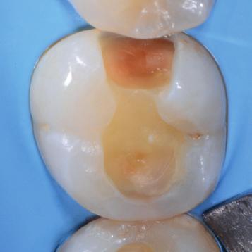compressive strength, and gloss retention. Esthetic restoration using Mosaic composite shades: A4, A3, A2, and A1 from cervical to incisal.