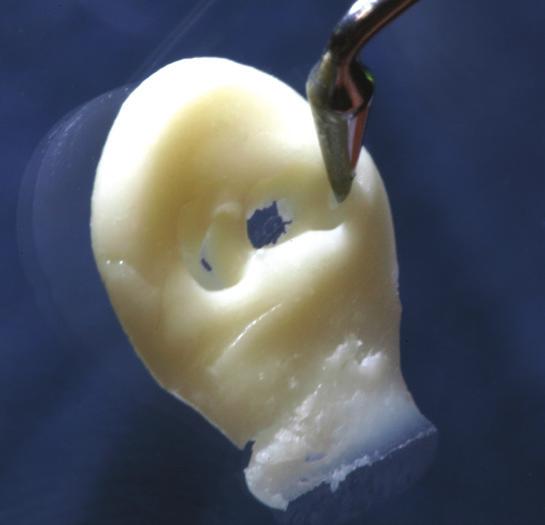 WORKING TIME AND HANDLING When reconstructing tooth anatomy accurately and efficiently, it is important that a restorative material does not pull, tug, or slump during manipulation.