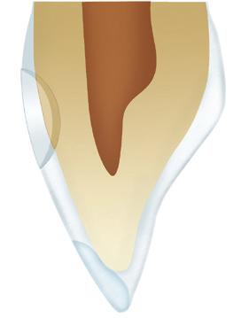 A (Yellow, Brown), B (Yellow), C (Gray, Brown), and D (Red, Brown) match the most common shades and translucency of natural teeth and are not intended to match any given shade system from another