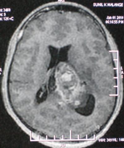 Hemorrhage and hemosiderin is noted suggestive of Subependymoma (WHO grade-1) Figure 2 Fig.2- MRI scan with contrast showing ill defined heterogeneous lesion with minimal contrast enhancement.