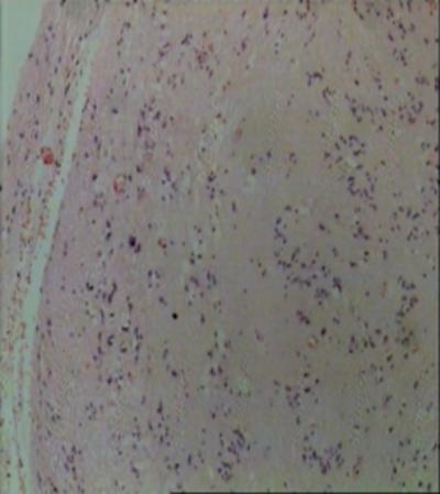 Figure 3 Fig. 3- Histopathological examination showing lobular pattern with clustering of tumor cells. Tumor cells were monomorphic, round to oval nuclei with bland chromatin. Figure 4 Fig.