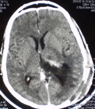 DISCUSSION Subependymoma is a rare, benign, usually asymptomatic, slowly growing glial tumor (WHO grade 1) with noninvasive charactestics. The incidence being 0.2-0.7% of all intracranial tumors (1).