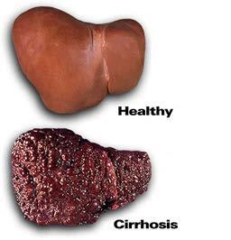 Chronic hepatitis Chronic hepatitis can lead to scarring of the