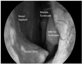 Deviated Nasal Septum One study reported septal spur or DNS incidence to be as high as 79% in humans. Can cause nasal dryness, nasal congestion and epistaxis.