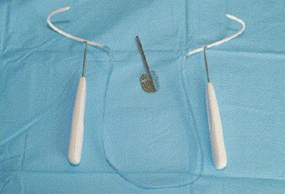 bladder trauma compared to TVT or colposuspension (12,13,14). Tension-free vaginal tape-secur (TVt-S) is a smaller device produced by Gynecare.