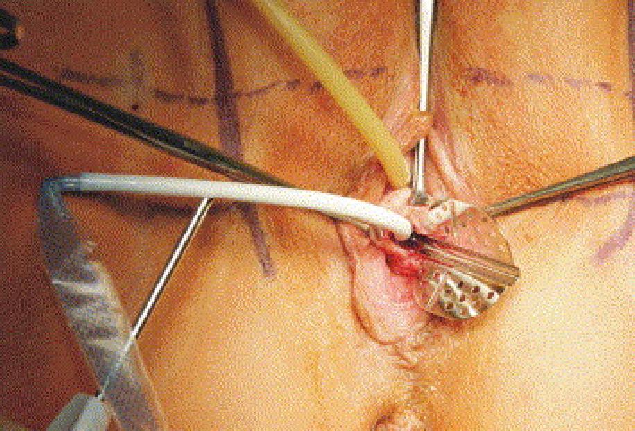 An introducer, with open-side of its gutter facing the surgeon (winged guide), is pushed along the performed dissection canal till it reaches and perforates the obturator membrane.