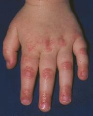 Dermatomyositis patients often complain of difficulty climbing stairs, rising from a seat, or combing their hair FIGURE 4 Papules on knuckles Erythematous papules located over the knuckles in a child
