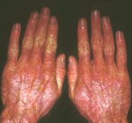 FIGURE 5 Sparing interphalangeal joints Erythematous rash sparing the skin overlying the proximal interphalangeal joints in a patient with SLE (Courtesy of the Division of Dermatology, UTHSCSA).