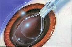 Under an operating microscope a small incision is made into the eye. State of the art technology enables your surgeon to remove the cloudy lens by a process known as phacoemulsification.