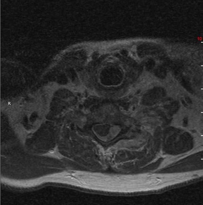 Refused to be admitted Repeat MRI with contrast: atypical infectious