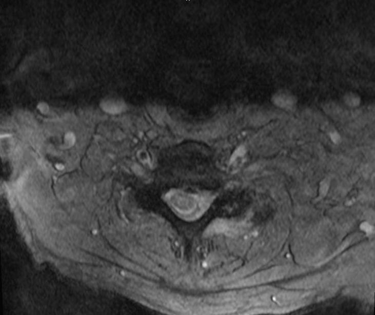 Suspected Cervical Etiology and referred for MRI an infiltrative process such as lymphoma is a consideration.
