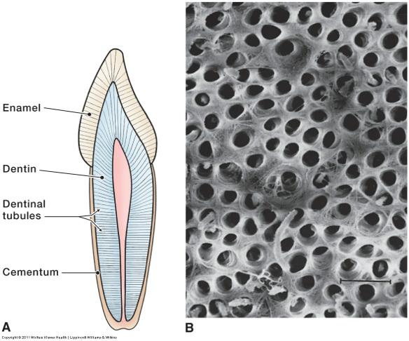 Dentinal Hypersensitivity Dentinal tubules penetrate the dentin. Tubules are long miniature tunnels extending through the dentin.