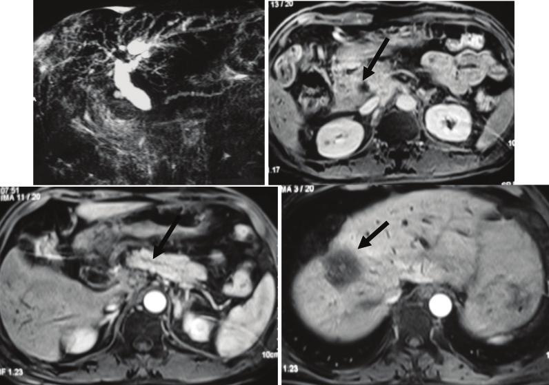 128 THAI J GASTROENTEROL 2016 Imaging of The Pancrease MRCP shows dilatation of pancreatic duct and its side branches without evidence of pancreatic mass.
