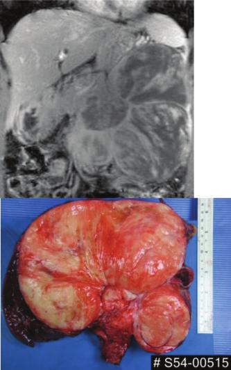 (8). It is a solid tumor but a cyst mimicker, showing high SI at T2 because of